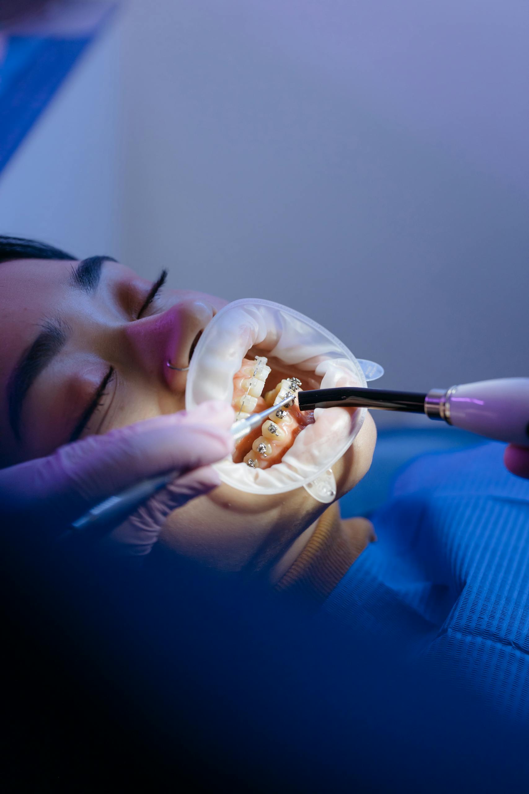 Patient receiving orthodontic treatment in a modern dental clinic, showcasing dental care techniques.